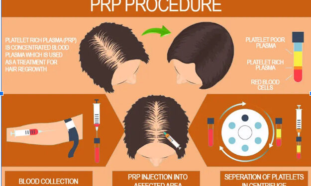 PRP in India for hair loss
