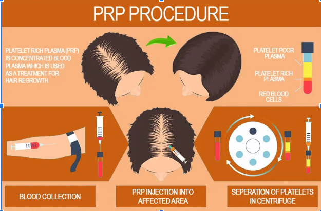 PRP in India for hair loss