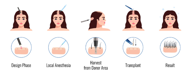 hair transplant