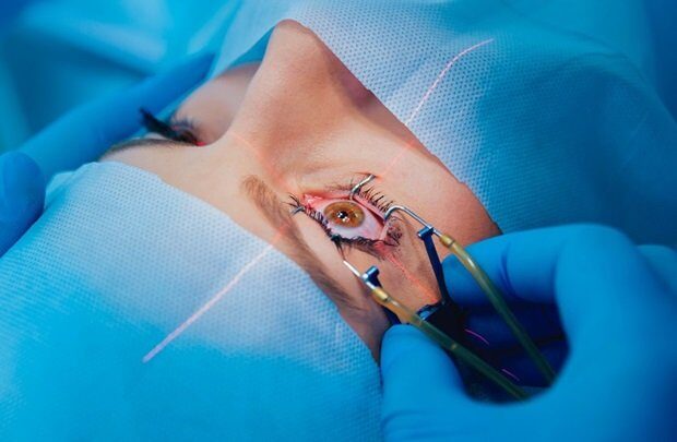 Close-up of a patient undergoing laser eye surgery, with a speculum holding the eye open and a surgeon using precision instruments.