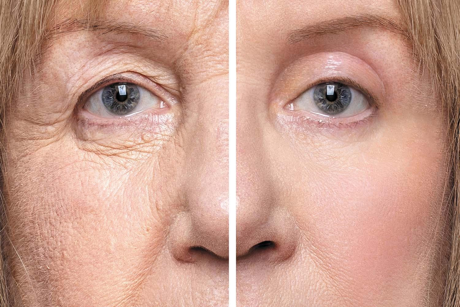 Eyelid Surgery