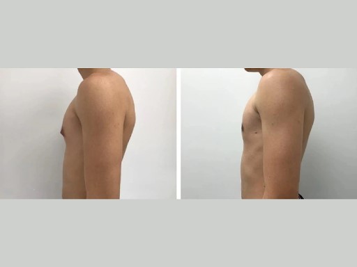 Gynecomastia surgery