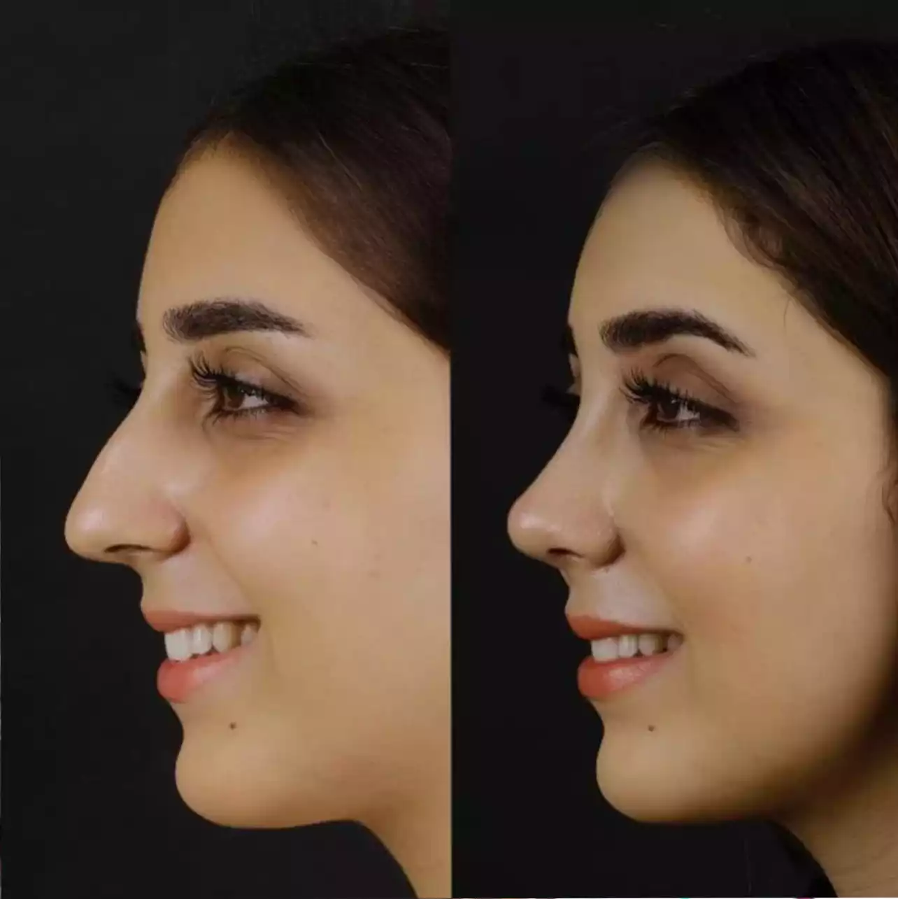 Minimally Invasive Options with a Septoplasty in Dubai