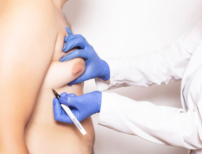 Male Breast