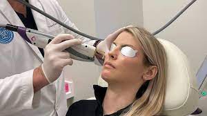 cool beam laser skin resurfacing