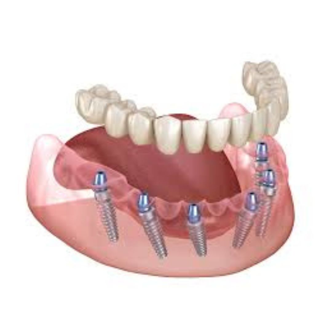 Whole mouth dental implants